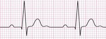 ecg