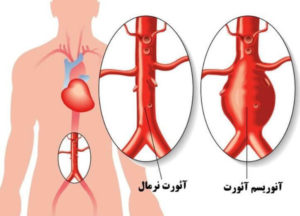 آنوریسم آئورت شکمی و روشهای درمانی آن