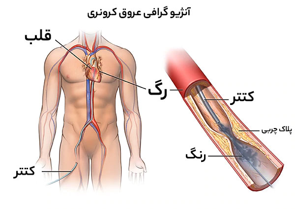 آنژیوگرافی قلب چیست
